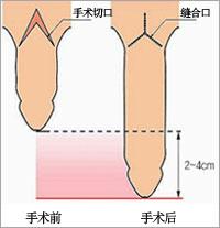 阴茎延长术是怎么回事?