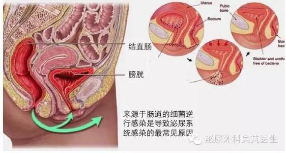 尿路感染时要做的检查