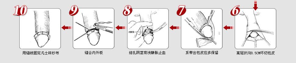 包皮环状切除术后不会对性敏感有影响