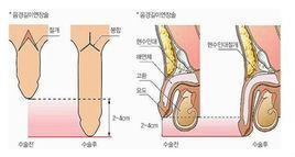 阴茎延长术有什么特点